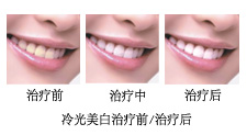 治疗药物变色牙的方法