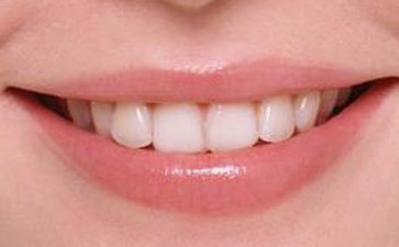 石家庄烤瓷牙多少钱