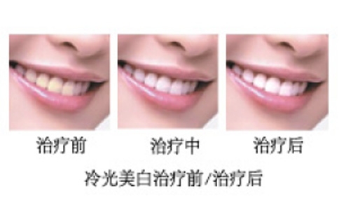 石家庄冷光美白的效果是多久