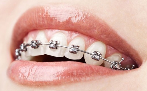 石家庄牙齿整形需要拔牙吗