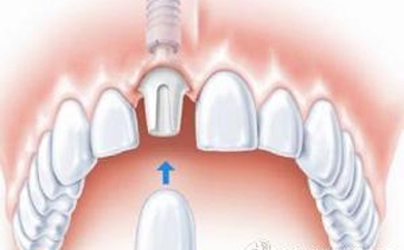 石家庄美容冠是什么