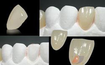 石家庄牙齿做瓷贴面多少钱