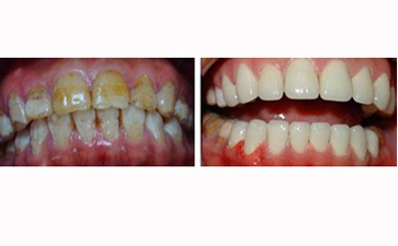 石家庄氟斑牙预防措施有哪些