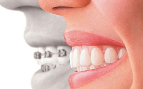 戴牙套需要注意哪些问题