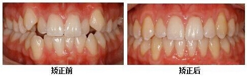 牙齿整形案例对比图