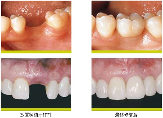 韩式即刻种植牙 给你人生第三幅牙齿  技术优势: (1)只需一次小手术