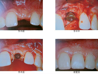 种植牙,牙齿,三博口腔,种植系统